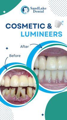 Before and After Cosmetic & Lumineers