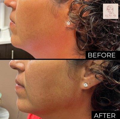 Jaw Line definition treatment