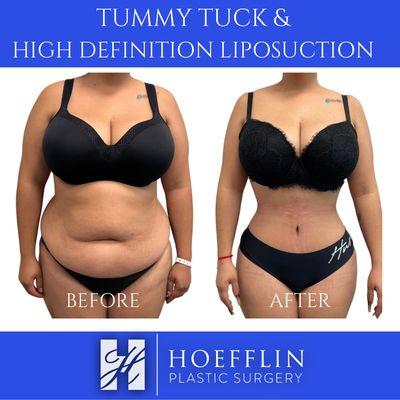 Dr. Hoefflin performs a specialized highly sculpted abdominoplasty (tummy tuck) procedure, including high definition liposuction of waists.