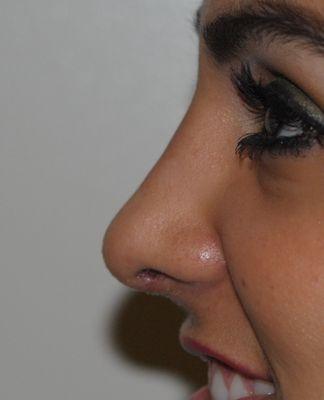 Rhinoplasty (nose job)
 After