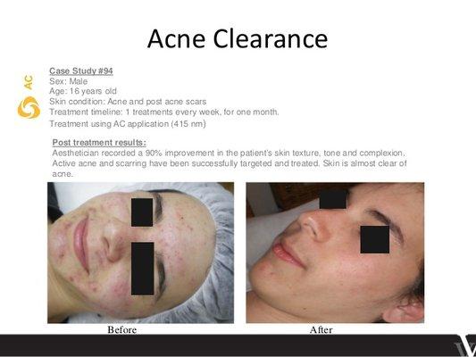 Acne Solutions