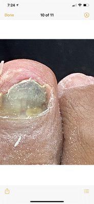 Fungus  nail