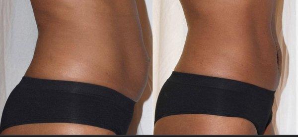 Cavitation and laser lipo