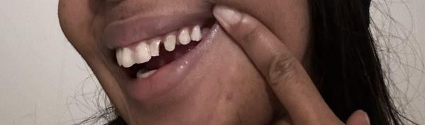 Chipped Tooth