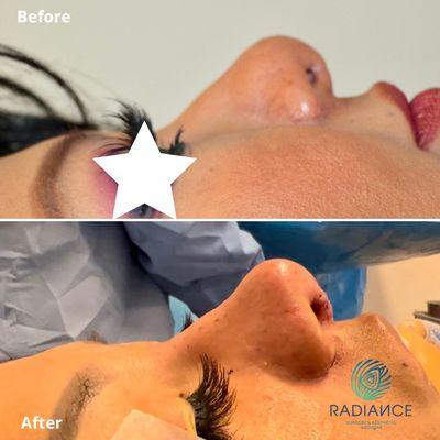 Revision Rhinoplasty by rhinoplasty specialist Dr. Carson Huynh