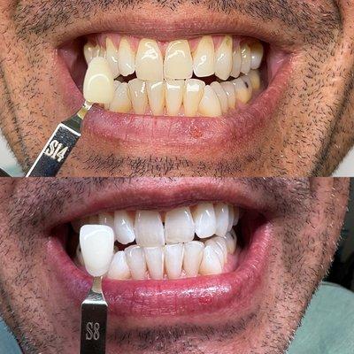 Before and after one teeth whitening treatment