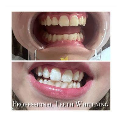 Professional Teeth Whitening on a juvenile. 12 yrs old