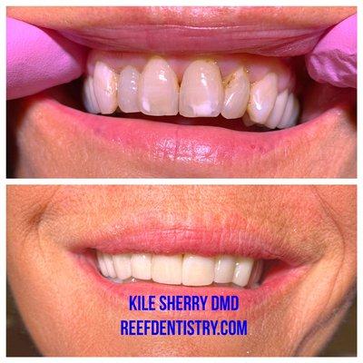 Cosmetic crown case completed by Dr. Kile Sherry