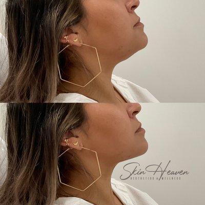 PDO Threads for Double Chin Tightening at Skin Heaven Aesthetics & Wellness