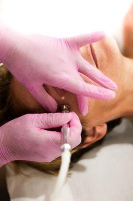 Microdermabrasion Treatment