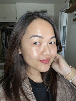 Completely peeled after 10 days. My skin looks radiant and glowy!!