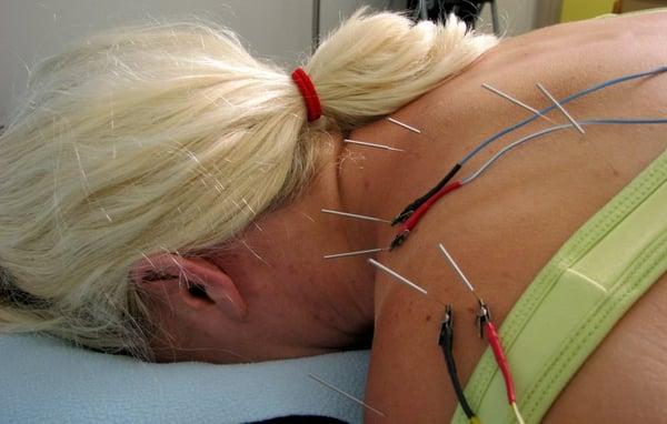 Electo-acupuncture