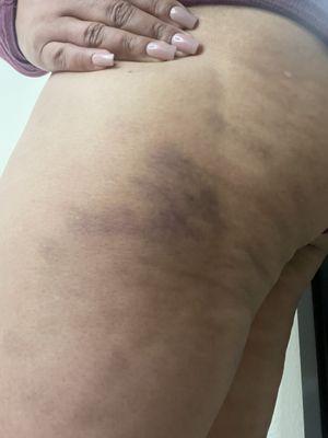 Bruises she gave me as she kept on using elbows even though I told her to go lighter on the pressure