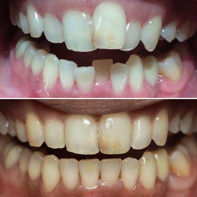 Before and After Invisalign treatment at Vida Dental