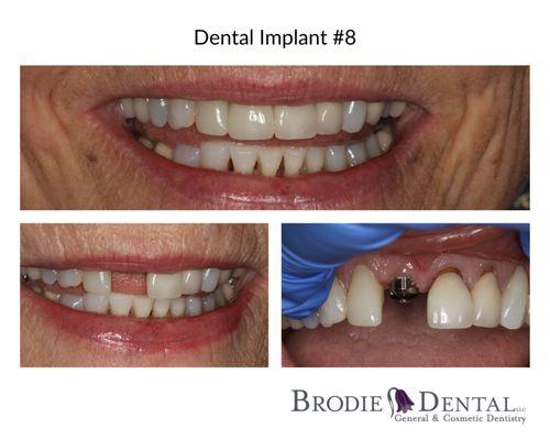 Missing teeth? Ask about dental implants and how they can transform your smile!