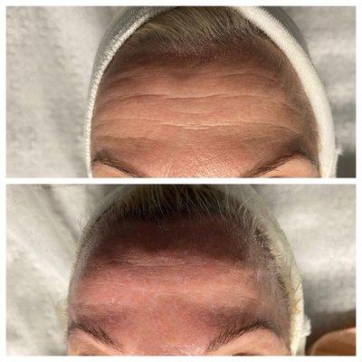 Endermolift before & after