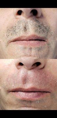 Before and after 1 hour upper lip treatment - removing black hairs only