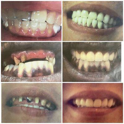 Cosmetic dentistry Before & After  photos