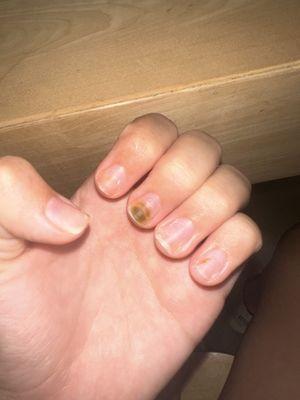 Nail Fungus