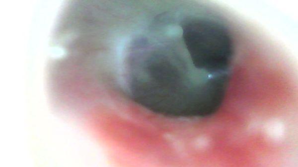 My ruptured ear drum post ENT cleaning