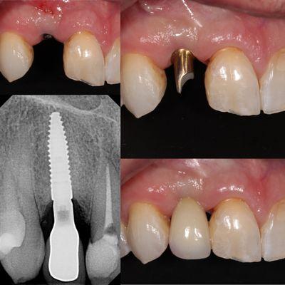 Single implant restoration for a patient that lost his tooth. Immediately restored!!