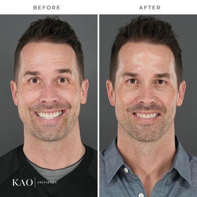 Before and after male neurotoxins - happy/smile face