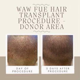 WAW System FUE + Post-op protocol = quick healing and minimal scarring