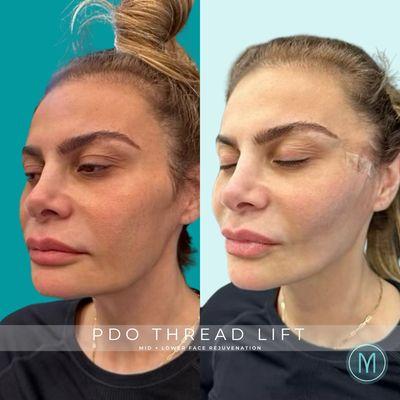 Non-surgical facelift using PDO Threads