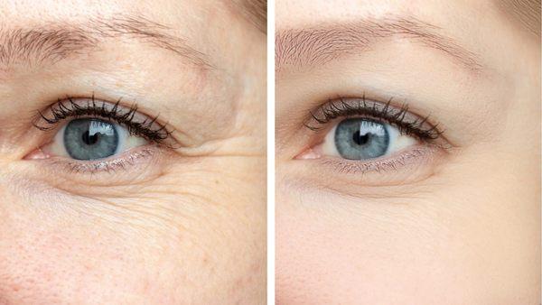 Reduce Fine Lines & Wrinkles...Before & After. Call Today.