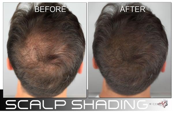 MicroArt Scalp Shading the solution for men & women with thinning hair.