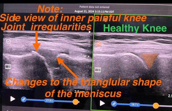 Check out the difference in the knee joint surfaces in someone with knee pain.  (Taken with permission)