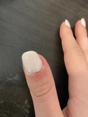 Cuticle fungal infection