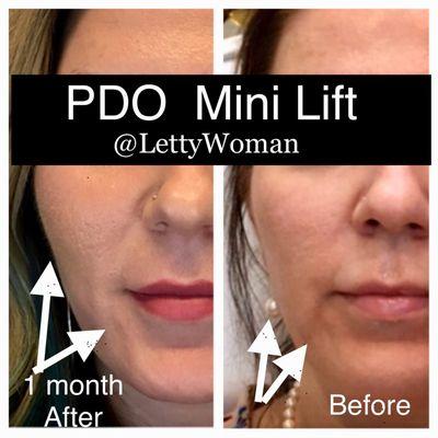 PDO Mini lift