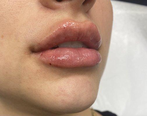 Post lip filler treatment