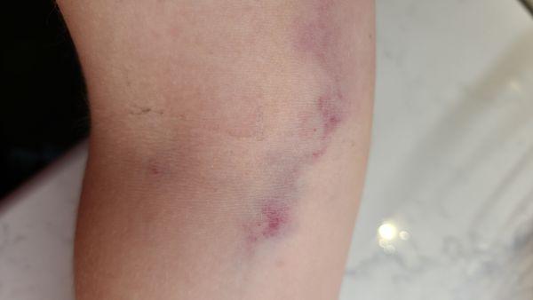 My daugher's arms after Dr. McAboy tried placing an iv 7 times and then didn't do the procedure