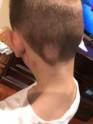 My son's bald spot and infection. Photo was taken three days after the haircut.