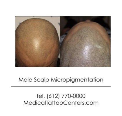 Men with receding hairlines can help cover it with scalp micropigmentation.