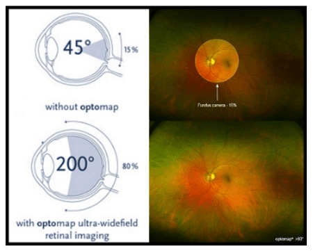 In one fast, easy capture, the Daytona Optomap captures an image of 82% of your retina.