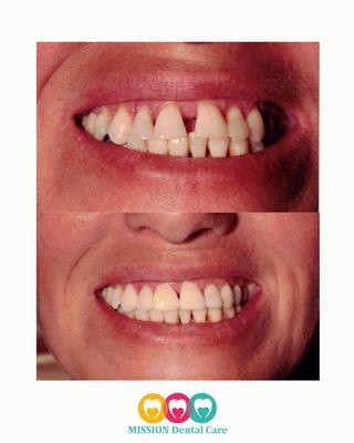 This patient came to us wanting to close their front gap. We bonded the two front teeth together to enhance their smile's natural beauty