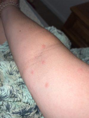 A few red bites on arm although there all over my body