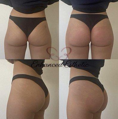 These are same day results of her second Buttlift session and the results speak for themselves