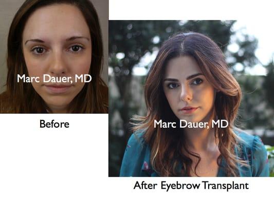 Beautiful eyebrow restoration