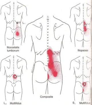 Common Trigger Point Referrals for Lower Back Pain