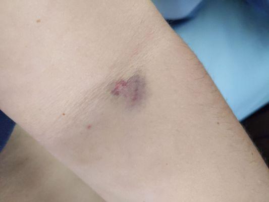 Bruised from my blood drawn