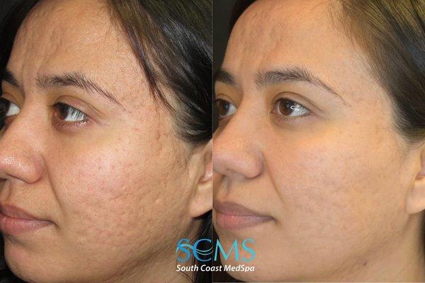 Before and After 3 customized Acne Scar Removal Treatments at SCMS