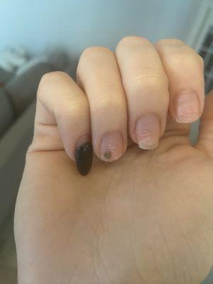 Bacterial infection on nail