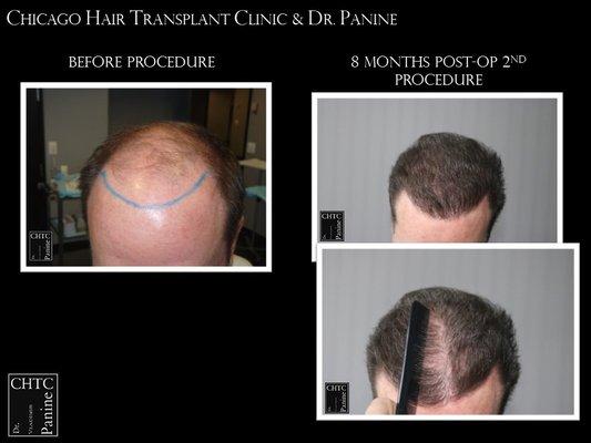 Hair transplant results for a patient of Dr. Panine and the Chicago Hair Transplant Clinic