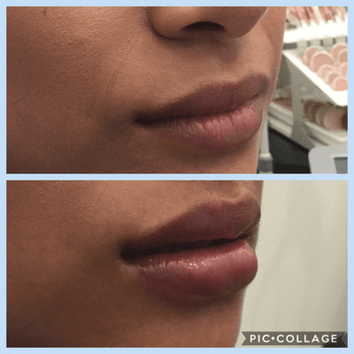 Juvederm Ultra for Plumper Lips By Renee R