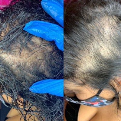 Scalp Pigmentation for Hair Loss