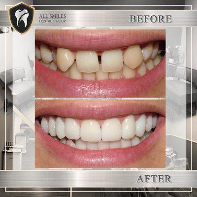 Whiter and brighter teeth with veneers